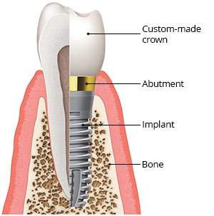 Single and multiple tooth implants