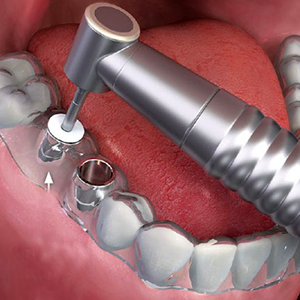 guided implant surgery